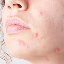 Actinic Keratosis Treatment in Dubai by Cosmocare Medical Center