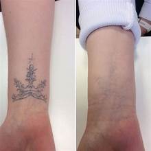 Tattoo Removal