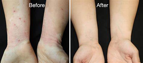 Eczema Doctor in Dubai by Cosmocare Medical Center