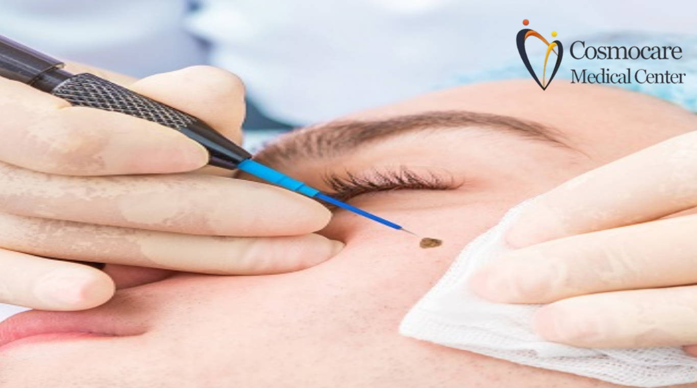 Facial Mole Removal in Dubai by Cosmocare Medical Center