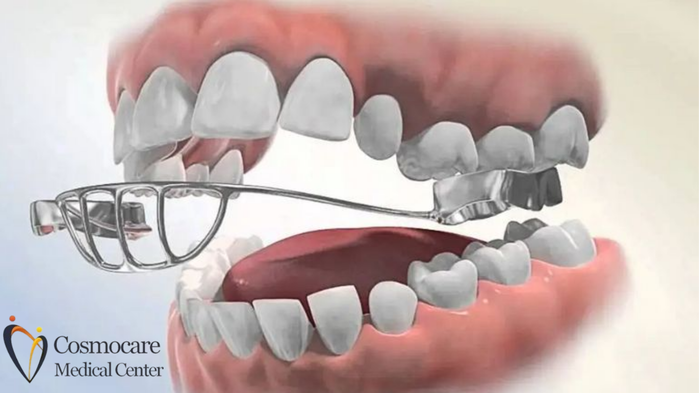 Palatal Expander Treatment Dubai by Cosmocare Medical Center