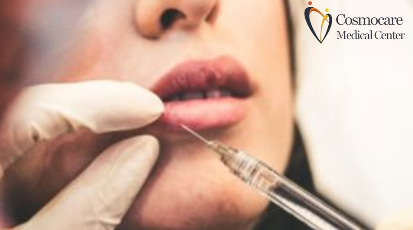 O  Smoker Lips Treatment In Dubai by Cosmocare Medical Center